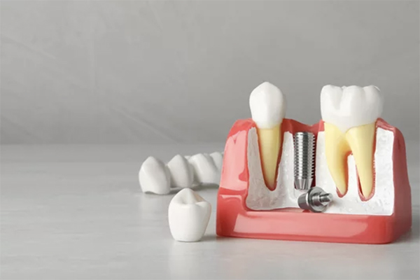 インプラントの注意点